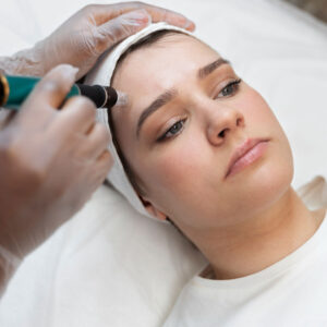 microdermoabrasion con puntas de diamante